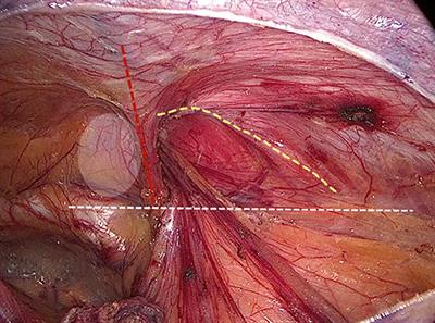 Internal Ring Defect Closure Technique in Laparoscopic Mesh Hernioplasty for Indirect Inguinal Hernia